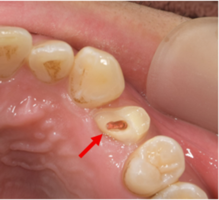 【症例】欠けてしまった歯に対する矯正的挺出術による保存治療｜松陰神社の歯医者せたがや歯科室｜ビフォー画像