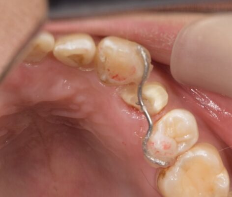 【症例】欠けてしまった歯に対する矯正的挺出術による保存治療｜松陰神社の歯医者せたがや歯科室｜治療経過①