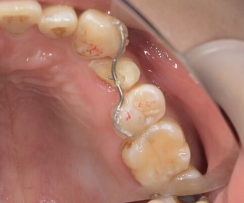 【症例】欠けてしまった歯に対する矯正的挺出術による保存治療｜松陰神社の歯医者せたがや歯科室｜治療経過②