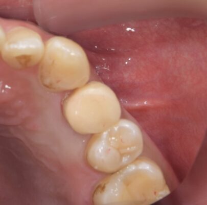 【症例】欠けてしまった歯に対する矯正的挺出術による保存治療｜松陰神社の歯医者せたがや歯科室｜治療経過④