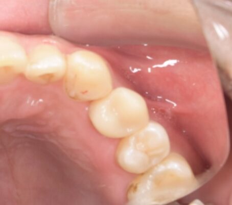 【症例】欠けてしまった歯に対する矯正的挺出術による保存治療｜松陰神社の歯医者せたがや歯科室｜治療経過⑤