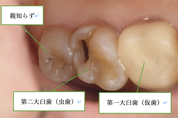治療前画像｜【症例】上顎臼歯部に対するZenoスターインレー／クラウン治療｜松陰神社の歯医者せたがや歯科室