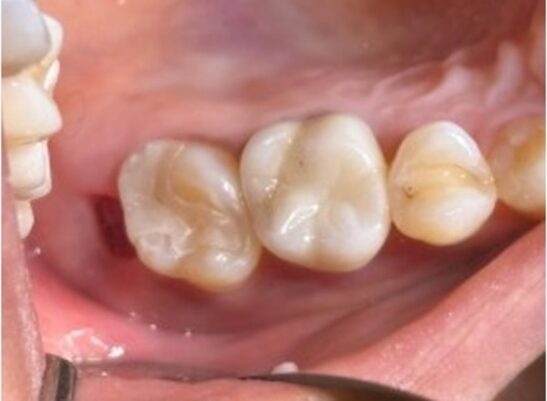 治療後画像｜【症例】上顎臼歯部に対するZenoスターインレー／クラウン治療｜松陰神社の歯医者せたがや歯科室