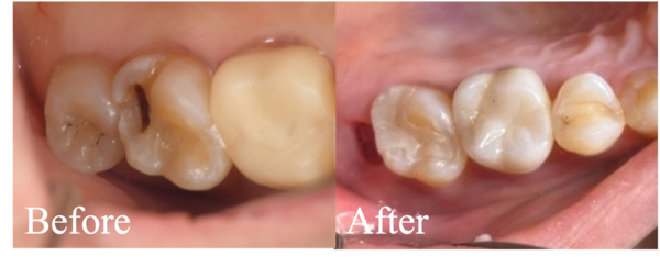 アイキャッチ画像｜【症例】上顎臼歯部に対するZenoスターインレー／クラウン治療｜松陰神社の歯医者せたがや歯科室