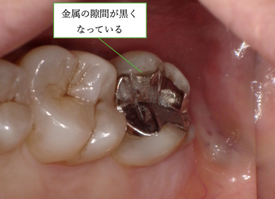 治療前画像｜【症例】金属アレルギー患者に対するe-maxによるセラミック治療｜松陰神社の歯医者せたがや歯科室
