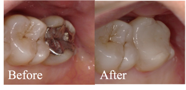 before-after画像｜【症例】金属アレルギー患者に対するe-maxによるセラミック治療｜松陰神社の歯医者せたがや歯科室