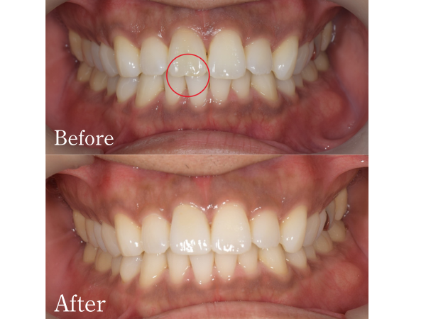 before-after画像｜【症例】神経を治療した歯に対するジルコニアセラミックの被せ物｜松陰神社の歯医者せたがや歯科室