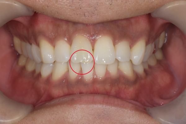 治療前の画像1｜【症例】神経を治療した歯に対するジルコニアセラミックの被せ物｜松陰神社の歯医者せたがや歯科室