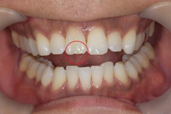 治療前の画像2｜【症例】神経を治療した歯に対するジルコニアセラミックの被せ物｜松陰神社の歯医者せたがや歯科室