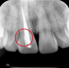 過去に神経の治療をしたことがわかるレントゲン画像｜【症例】神経を治療した歯に対するジルコニアセラミックの被せ物｜松陰神社の歯医者せたがや歯科室