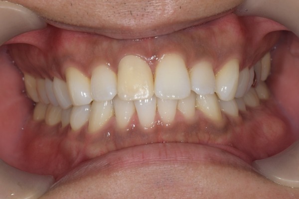 仮歯の状態1｜【症例】神経を治療した歯に対するジルコニアセラミックの被せ物｜松陰神社の歯医者せたがや歯科室