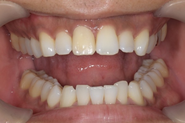 仮歯の状態2｜【症例】神経を治療した歯に対するジルコニアセラミックの被せ物｜松陰神社の歯医者せたがや歯科室