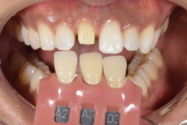 色合わせしている口腔写真｜【症例】神経を治療した歯に対するジルコニアセラミックの被せ物｜松陰神社の歯医者せたがや歯科室