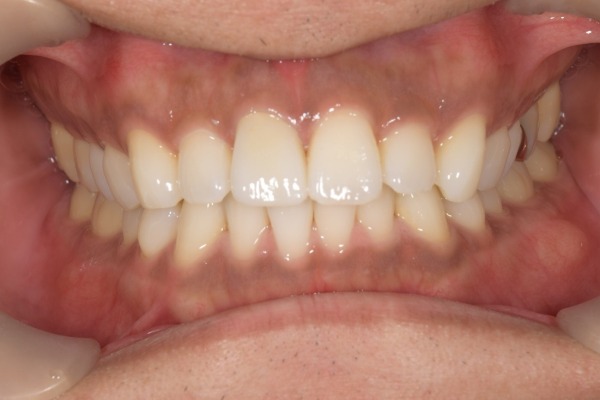 治療後1｜【症例】神経を治療した歯に対するジルコニアセラミックの被せ物｜松陰神社の歯医者せたがや歯科室