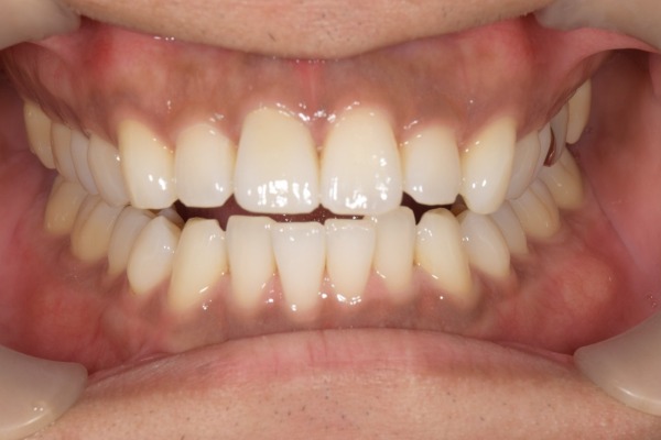 治療後2｜【症例】神経を治療した歯に対するジルコニアセラミックの被せ物｜松陰神社の歯医者せたがや歯科室