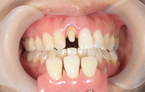 歯を削った後の画像｜【症例】変色した前歯をe-maxで治療｜松陰神社の歯医者　せたがや歯科室