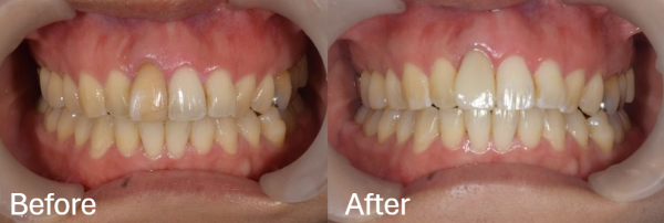ビフォーアフター画像｜【症例】変色した前歯をe-maxで治療｜松陰神社の歯医者　せたがや歯科室