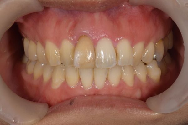 治療前画像｜【症例】変色した前歯をe-maxで治療｜松陰神社の歯医者　せたがや歯科室