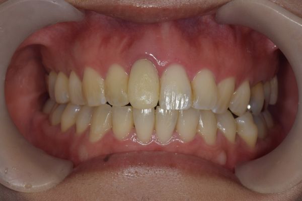 仮歯がはいった画像｜【症例】変色した前歯をe-maxで治療｜松陰神社の歯医者　せたがや歯科室