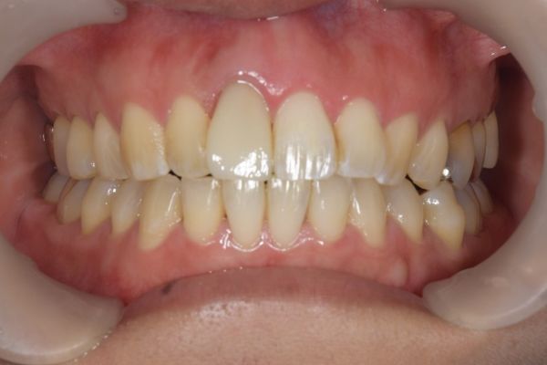 治療後画像｜【症例】変色した前歯をe-maxで治療｜松陰神社の歯医者　せたがや歯科室